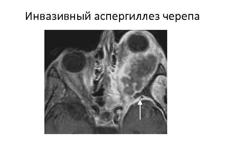 Инвазивный аспергиллез черепа 