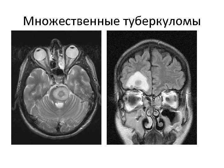 Множественные туберкуломы 