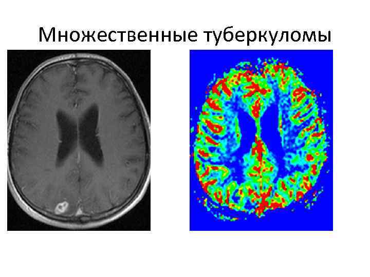 Множественные туберкуломы 