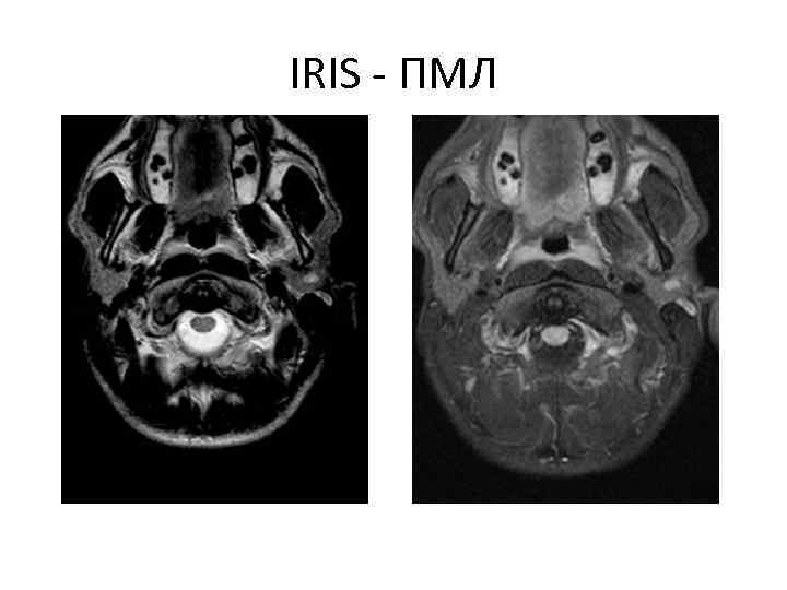 IRIS - ПМЛ 