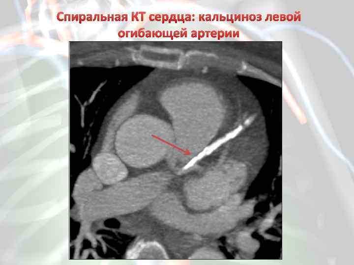 Спиральная КТ сердца: кальциноз левой огибающей артерии 