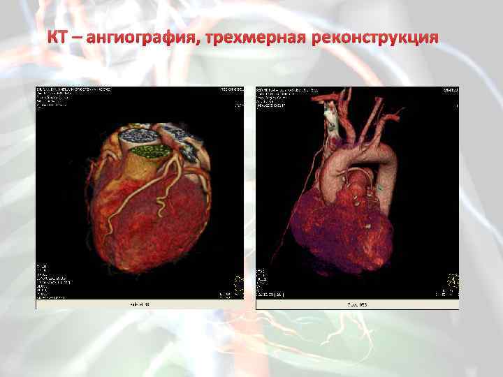 КТ – ангиография, трехмерная реконструкция 