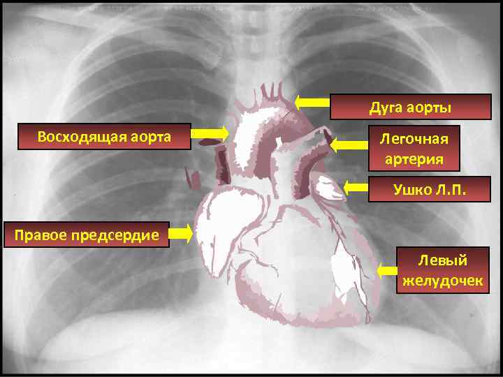 Левое предсердие легочная артерия