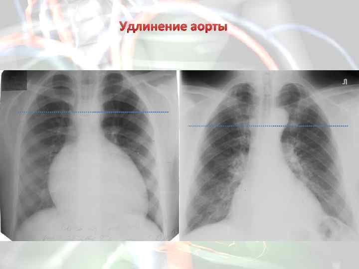 Аорта уплотнена. Атеросклероз аорты рентген. Дуна аопты на рентгене. Аневризма аорты на флюорографии. Атеросклероз дуги аорты рентген.