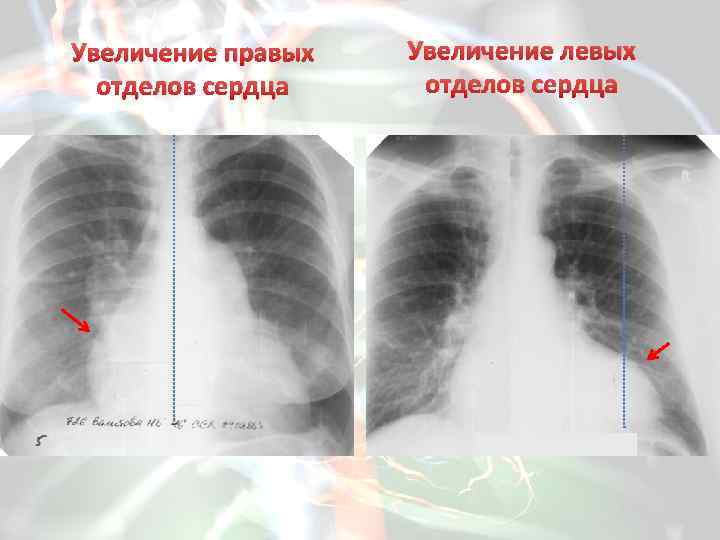 Дилатация правых отделов. Гипертрофия левого желудочка рентген. Гипертрофия правых отделов сердца рентген. Гипертрофия правого желудочка рентген. Гипертрофия правого желудочка на рентгенограмме.