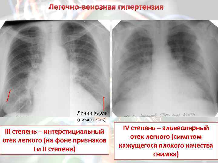 Отек легких рентгенологическая картина