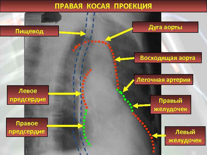 Косая проекция. Левая косая проекция сердца. Правая косая проекция сердца. Рентген сердца в правой косой проекции. Левая косая проекция сердца на рентгенограмме.