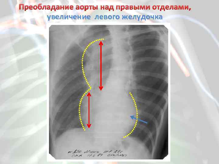 Преобладание аорты над правыми отделами, увеличение левого желудочка 