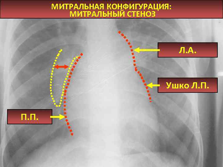 Талия сердца