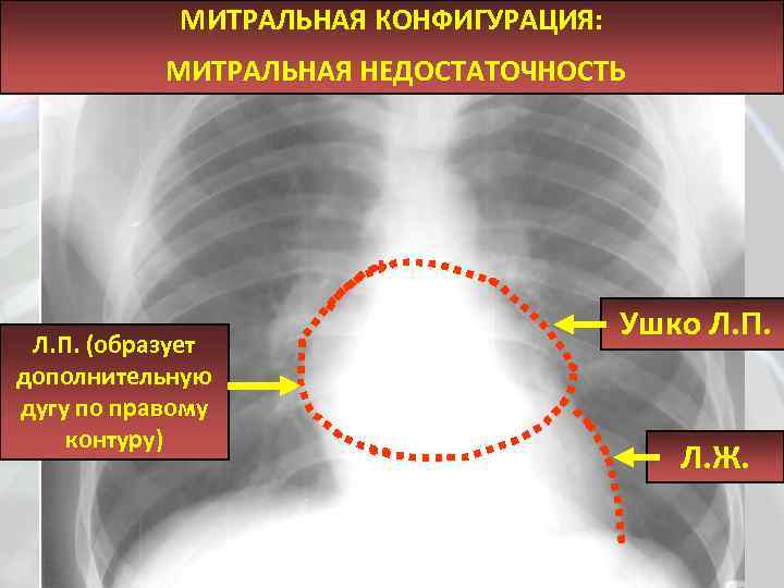 Митральное сердце. Митральная конфигурация сердца рентген. Митральная недостаточность рентгенограмма. Недостаточность митрального клапана рентгенография. Патологические конфигурации сердца рентген.