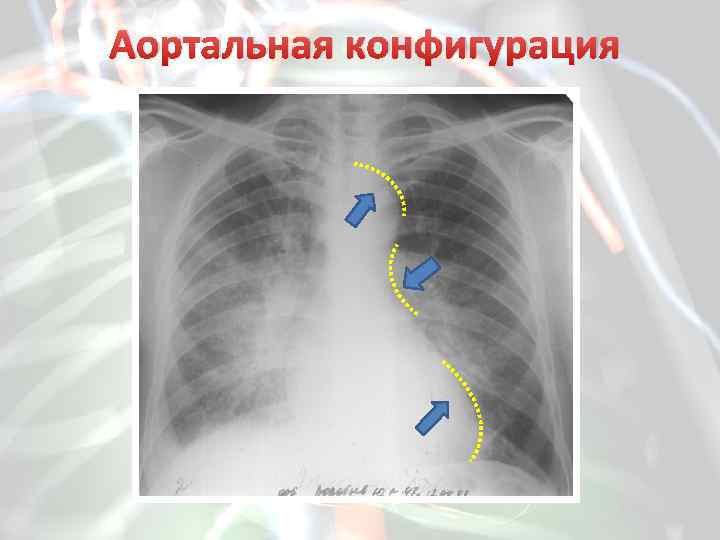 Аортальная конфигурация сердца. Аортальная конфигурация сердца рентген. Рентгенограмма с аортальной конфигурацией. Аортальная недостаточность конфигурация сердца. Аортальный стеноз рентген.