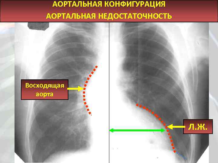 АОРТАЛЬНАЯ КОНФИГУРАЦИЯ АОРТАЛЬНАЯ НЕДОСТАТОЧНОСТЬ Восходящая аорта Л. Ж. 