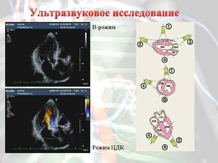 Ультразвуковое исследование В-режим Режим ЦДК 