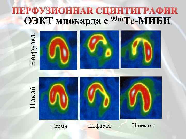 Презентация сцинтиграфия миокарда