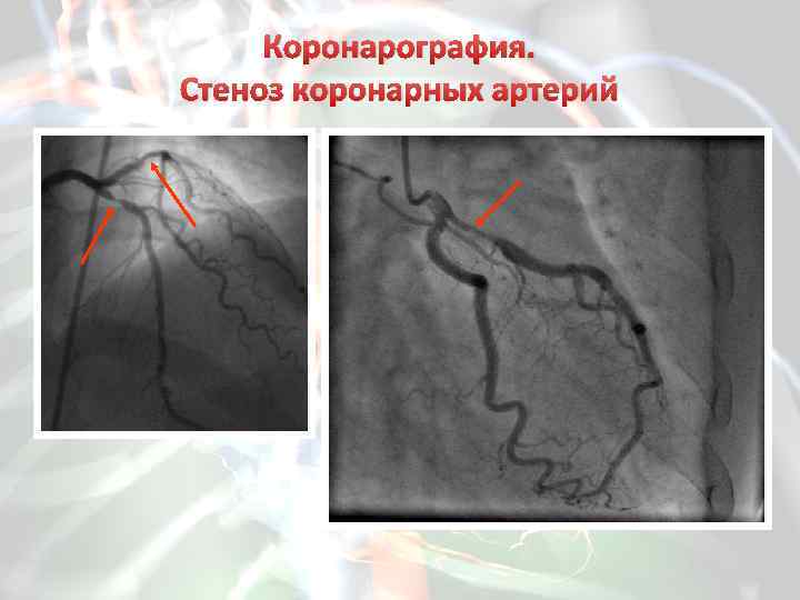 Коронарография фото с описанием патологии