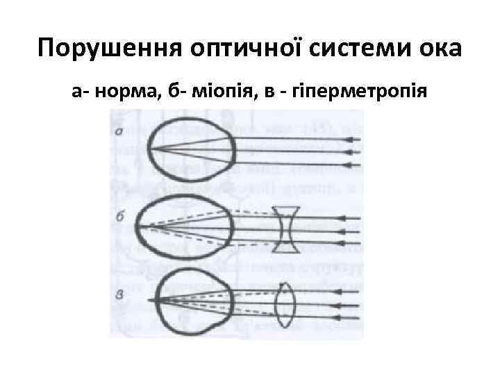 Порушення оптичної системи ока а- норма, б- міопія, в - гіперметропія 