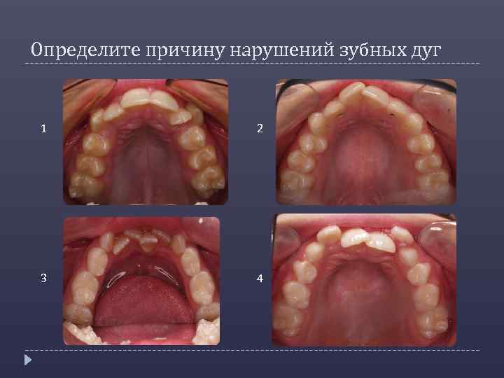 Определите причину нарушений зубных дуг 1 2 3 4 