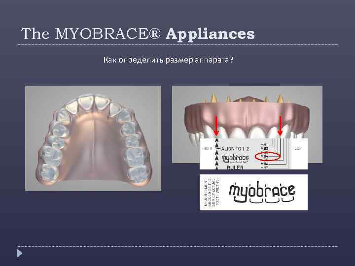 The MYOBRACE® Appliances Как определить размер аппарата? 