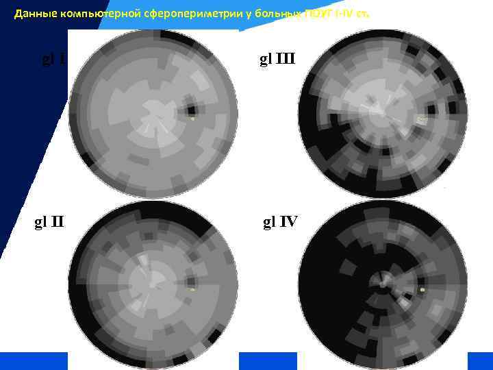 Данные компьютерной сферопериметрии у больных ПОУГ I-IV ст. gl III gl IV 