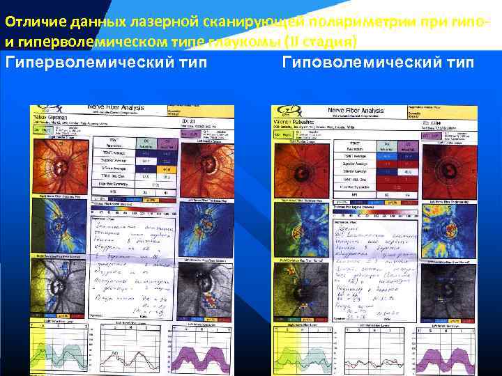 Отличие данных лазерной сканирующей поляриметрии при гипои гиперволемическом типе глаукомы (II стадия) Гиперволемический тип