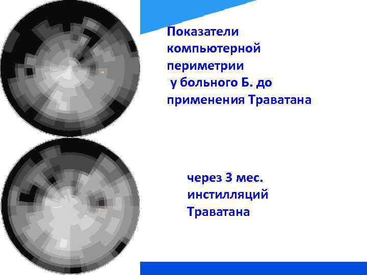 Показатели компьютерной периметрии у больного Б. до применения Траватана через 3 мес. инстилляций Траватана