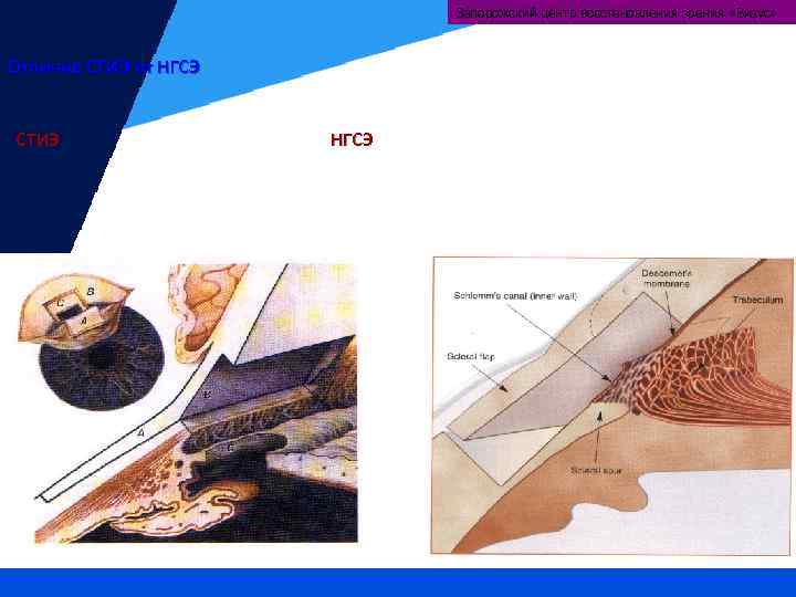 Запорожский центр восстановления зрения «Визус» Отличие СТИЭ от НГСЭ СТИЭ НГСЭ 