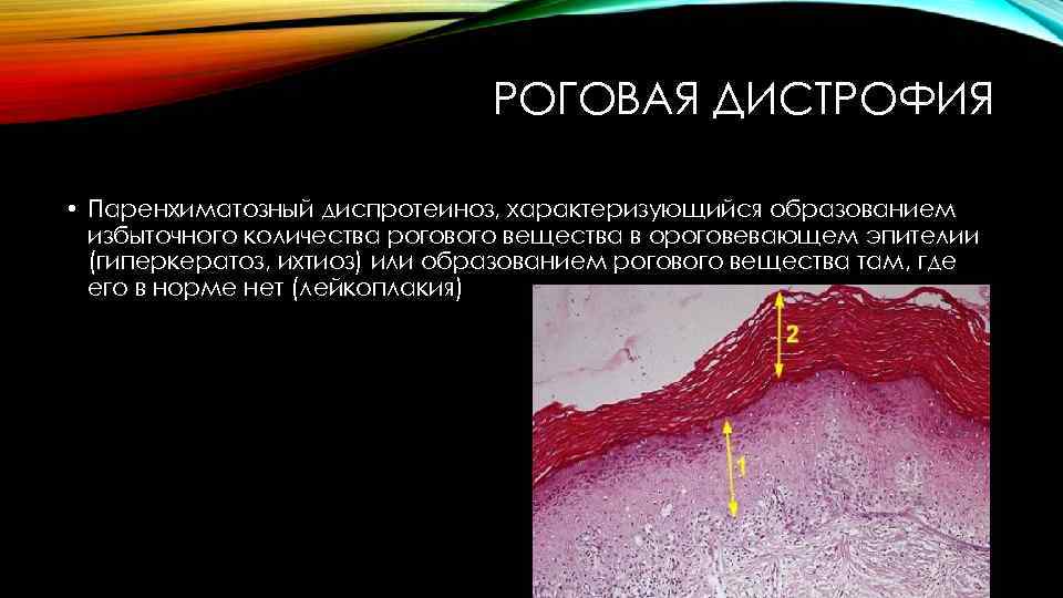 РОГОВАЯ ДИСТРОФИЯ • Паренхиматозный диспротеиноз, характеризующийся образованием избыточного количества рогового вещества в ороговевающем эпителии