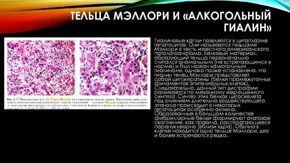 ТЕЛЬЦА МЭЛЛОРИ И «АЛКОГОЛЬНЫЙ ГИАЛИН» • Гиалиновые капли появляются в цитоплазме гепатоцитов. Они называются