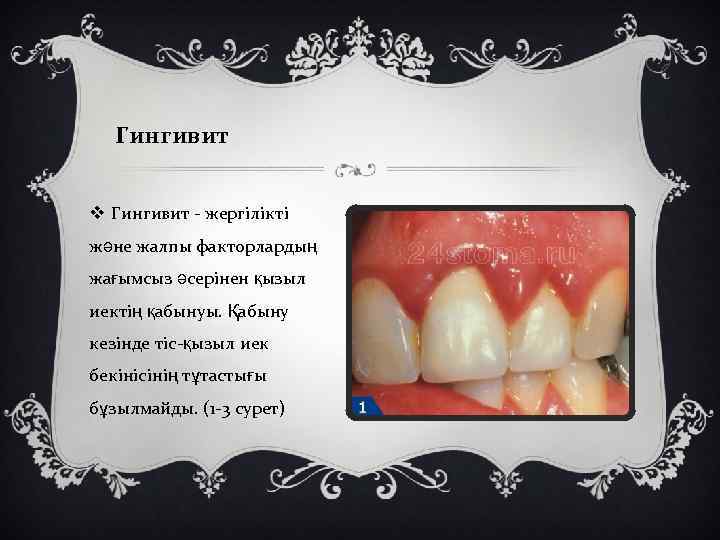 Гингивит v Гингивит - жергілікті және жалпы факторлардың жағымсыз әсерінен қызыл иектің қабынуы. Қабыну