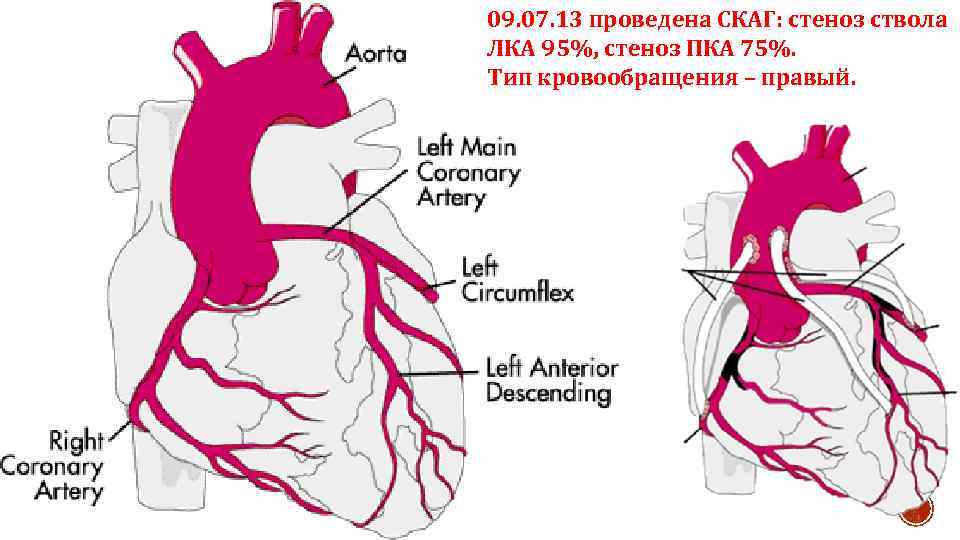 09. 07. 13 проведена СКАГ: стеноз ствола ЛКА 95%, стеноз ПКА 75%. Тип кровообращения