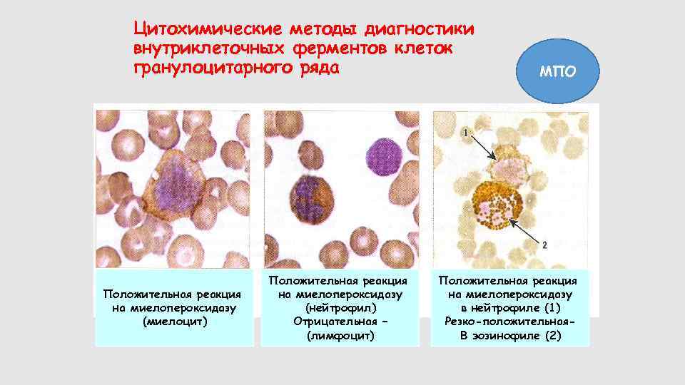 Цитохимические методы диагностики внутриклеточных ферментов клеток гранулоцитарного ряда Положительная реакция на миелопероксидазу (миелоцит) Положительная