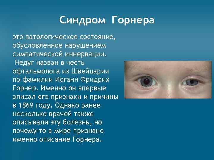 Синдром Горнера это патологическое состояние, обусловленное нарушением симпатической иннервации. Недуг назван в честь офтальмолога