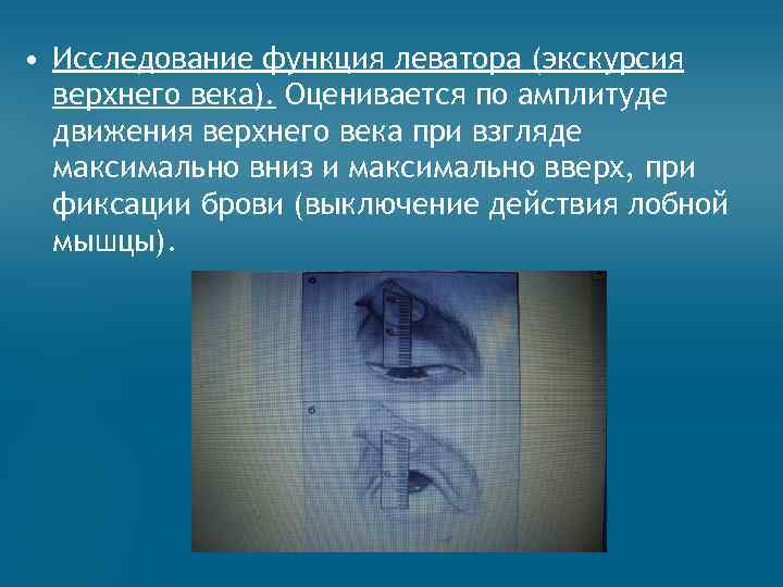  • Исследование функция леватора (экскурсия верхнего века). Оценивается по амплитуде движения верхнего века