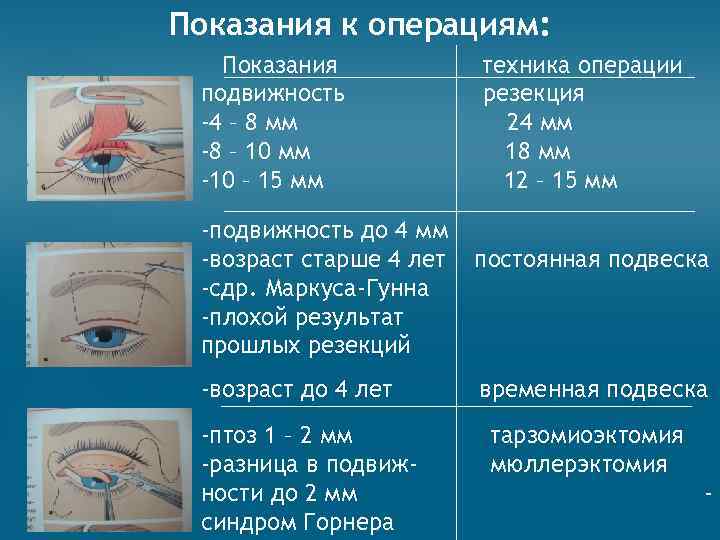 Показания к операциям: Показания подвижность -4 – 8 мм -8 – 10 мм -10