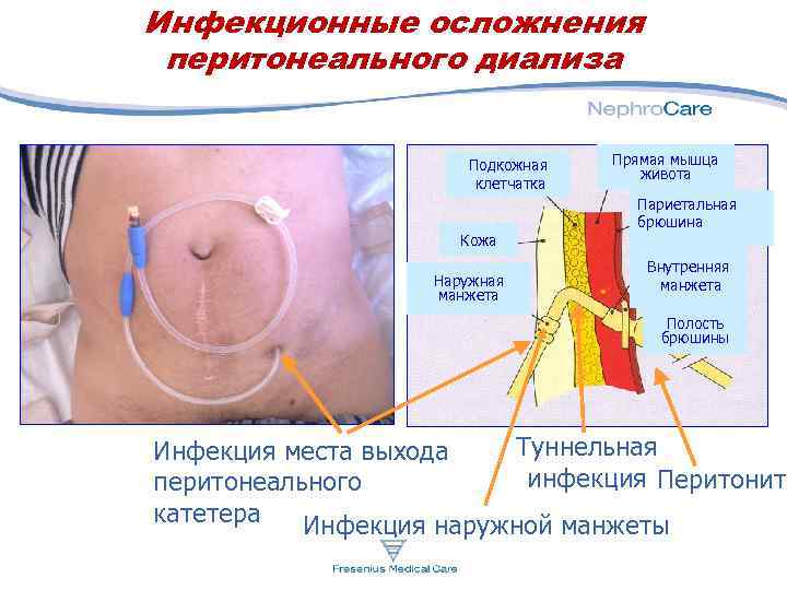 Инфекционные осложнения перитонеального диализа Подкожная клетчатка Кожа Наружная манжета Прямая мышца живота Париетальная брюшина