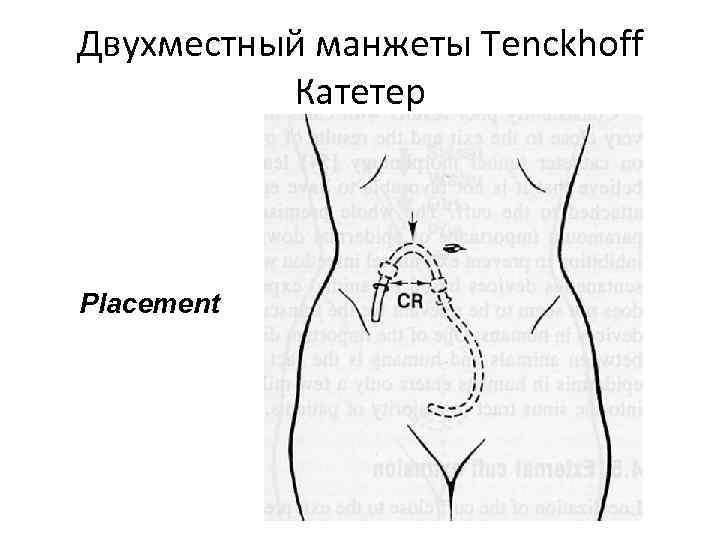 Двухместный манжеты Tenckhoff Катетер Placement 