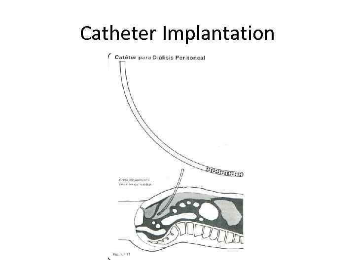 Catheter Implantation 
