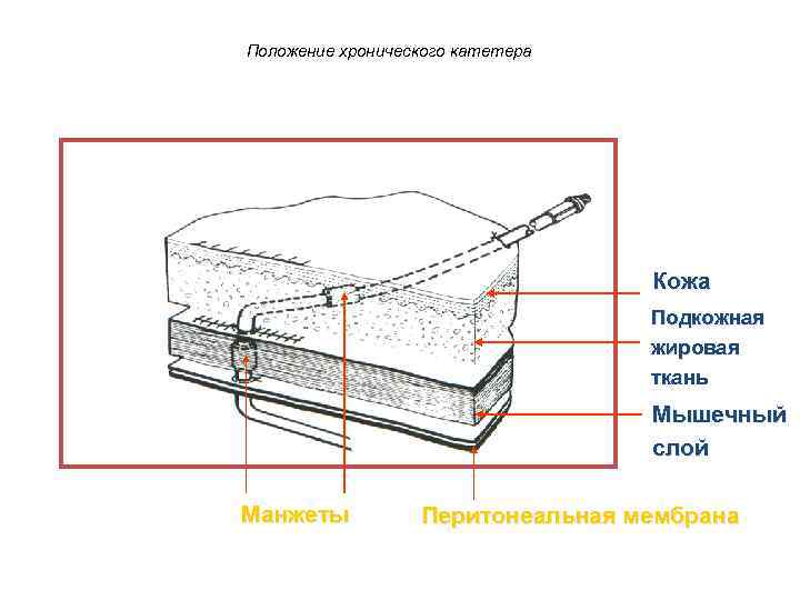 Положение хронического катетера Кожа Подкожная жировая ткань Мышечный слой Манжеты Перитонеальная мембрана 