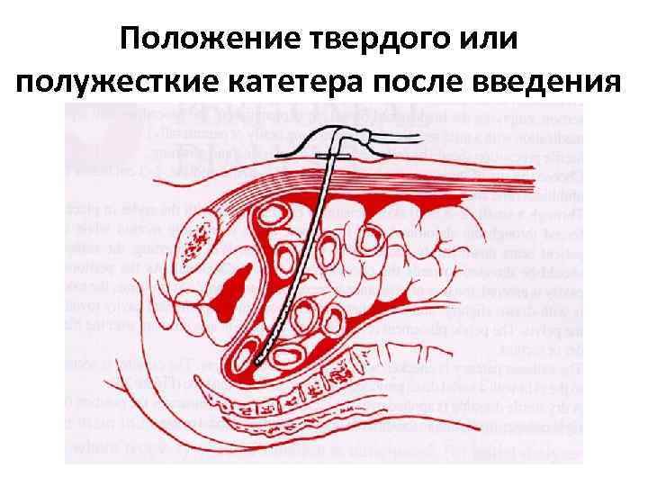 Положение твердого или полужесткие катетера после введения 
