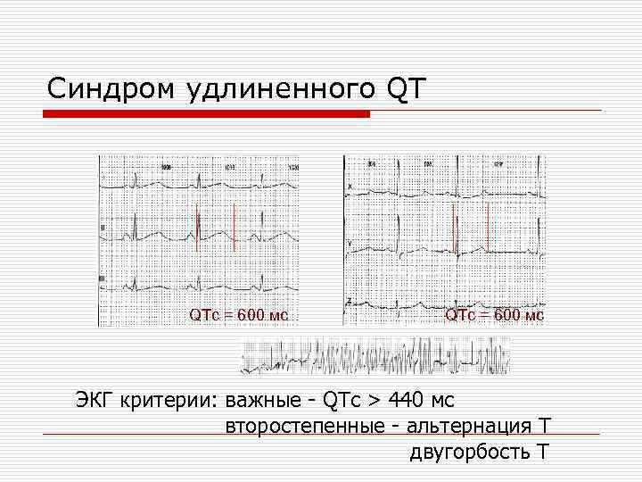 Cиндром удлиненного QT QTc = 600 мс ЭКГ критерии: важные - QTc > 440