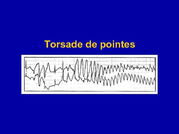 Torsade de pointes 