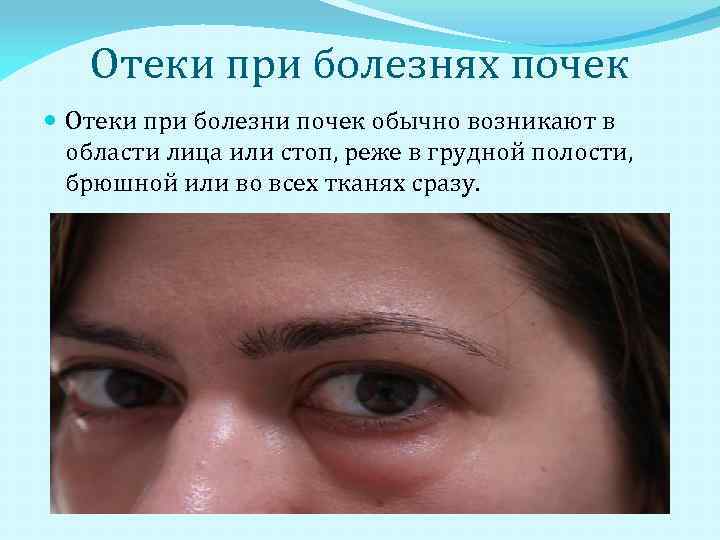 Отекшие глаза причины и лечение у женщин. Почечные отеки под глазами. Почечные отеки проявление отеков.