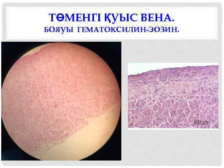 ТӨМЕНГІ ҚУЫС ВЕНА. БОЯУЫ ГЕМАТОКСИЛИН-ЭОЗИН. 