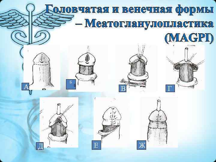 Головчатая и венечная формы – Меатогланулопластика (МAGPI) Б Б А Д В Е Г