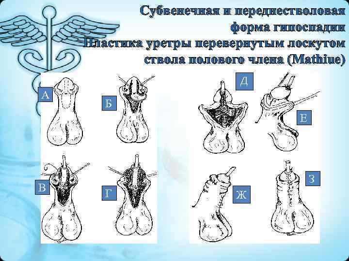  Субвенечная и переднестволовая форма гипоспадии Пластика уретры перевернутым лоскутом ствола полового члена (Мathiue)