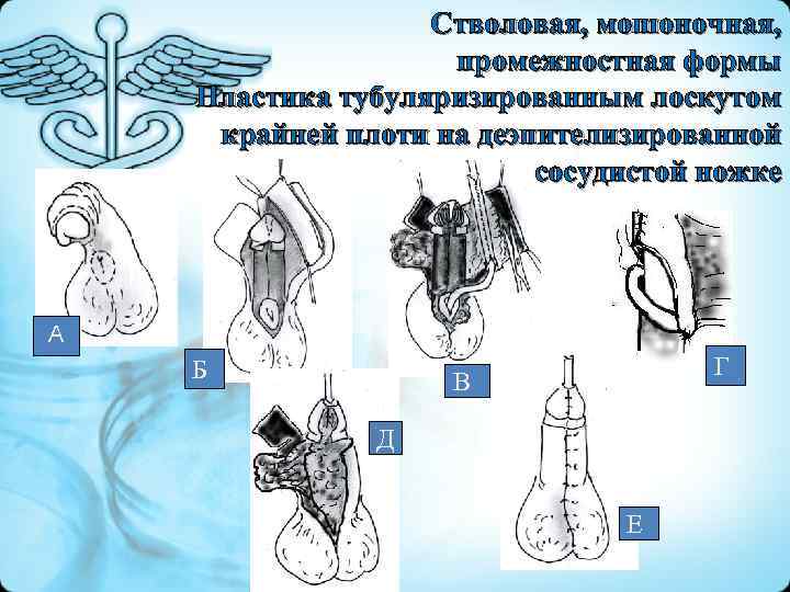  Стволовая, мошоночная, промежностная формы Пластика тубуляризированным лоскутом крайней плоти на деэпителизированной сосудистой ножке