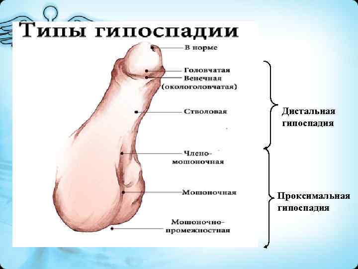 Дистальная гипоспадия Проксимальная гипоспадия 