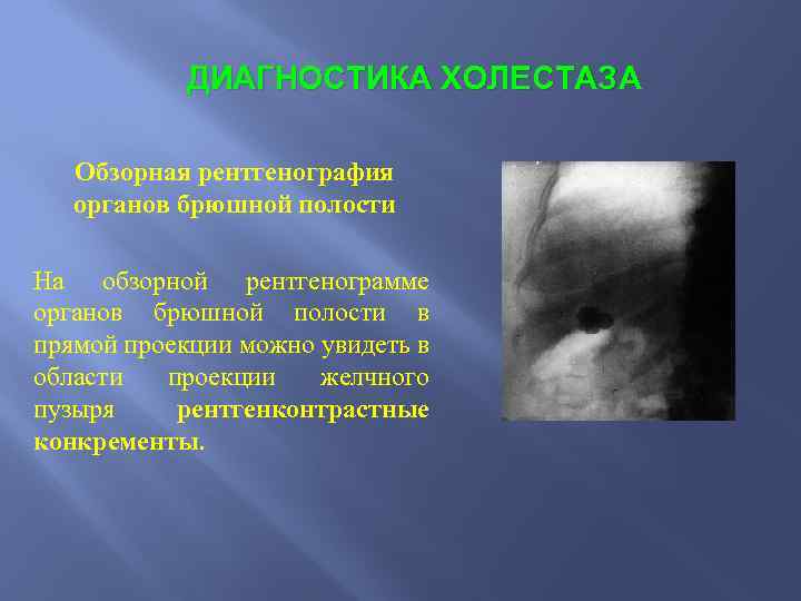 ДИАГНОСТИКА ХОЛЕСТАЗА Обзорная рентгенография органов брюшной полости На обзорной рентгенограмме органов брюшной полости в