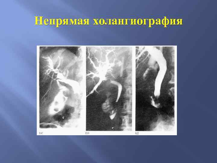 Непрямая холангиография 
