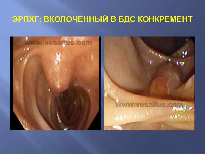 ЭРПХГ: ВКОЛОЧЕННЫЙ В БДС КОНКРЕМЕНТ 